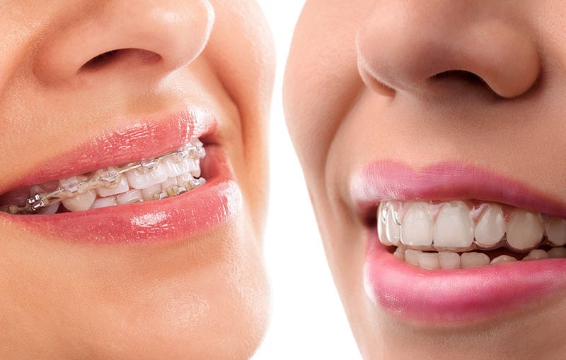 Invisalign vs Braces: Which is Better?