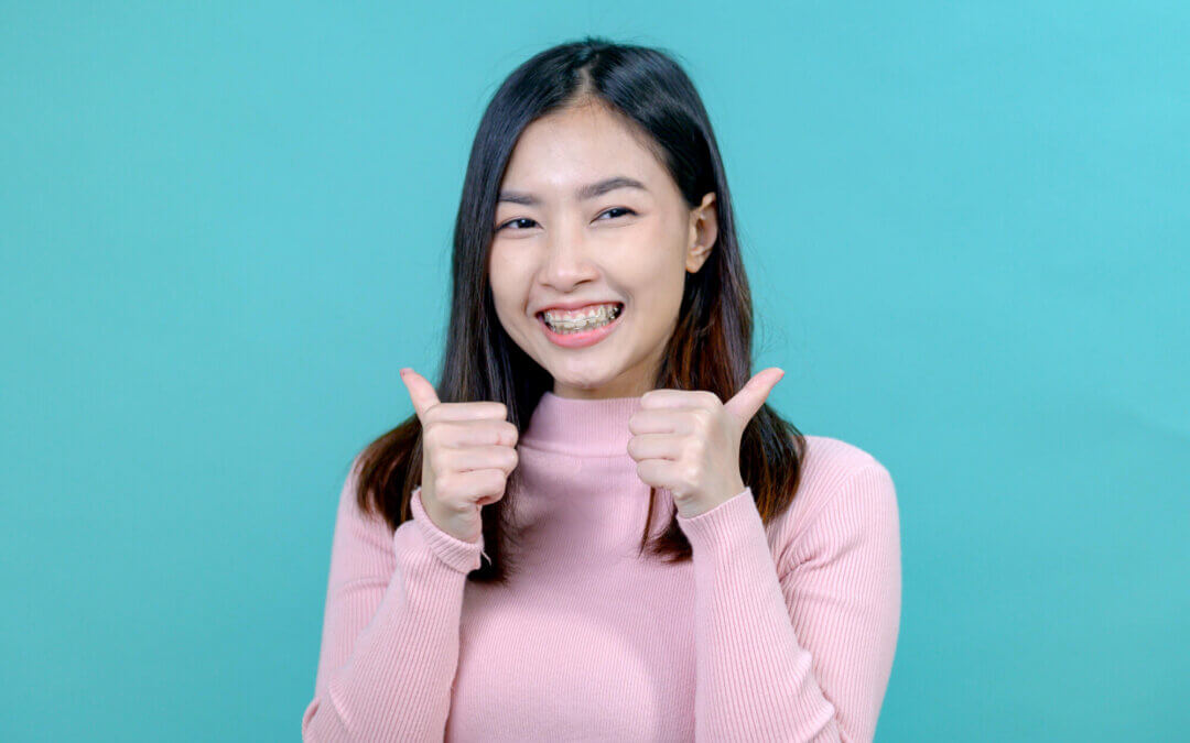 invisalign aligners